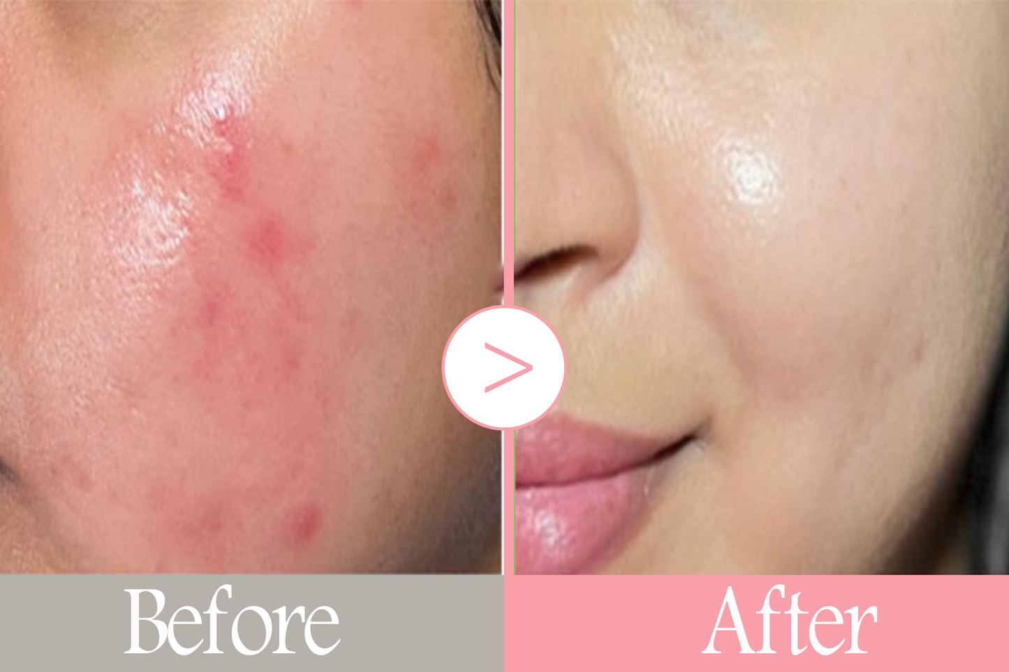 Nouelv Salmon DNA PDRN Pink Collagen Jelly Pads – Korean Wet Compress Toner Pads